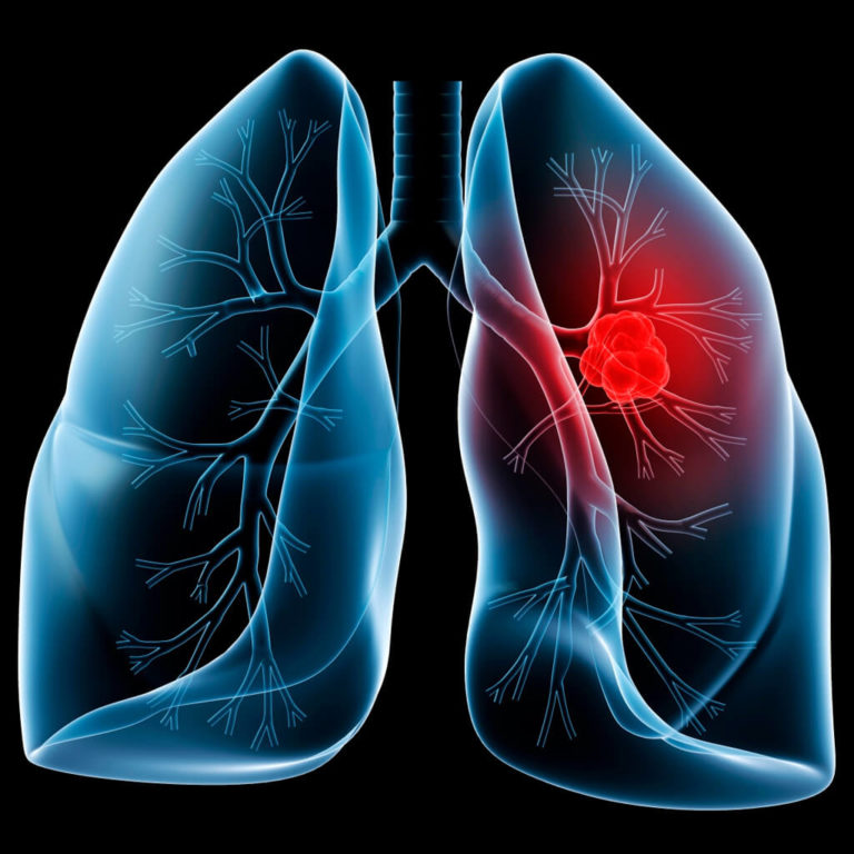 El 48% de los pacientes con ETV desarrollan embolia pulmonar